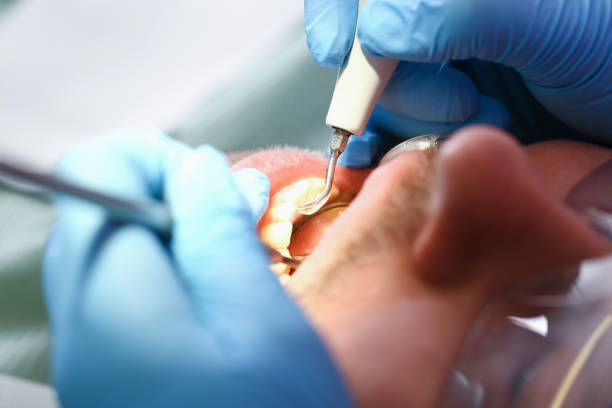 Best Emergency Dentist for Knocked-Out Tooth in Phoenix Lake, CA